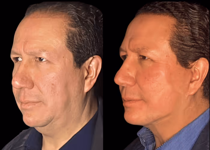 Facelift before and after — male patient, three-quarter view