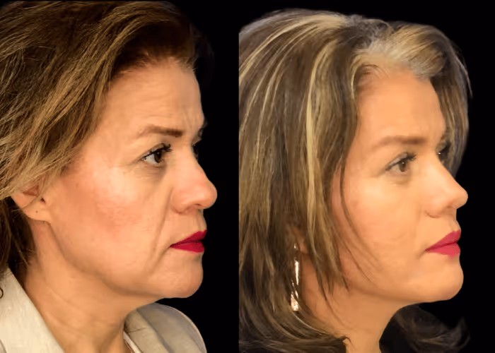 Facelift before and after — female patient, profile view