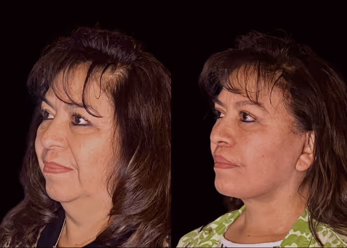 Facelift before and after — female patient, three-quarter view