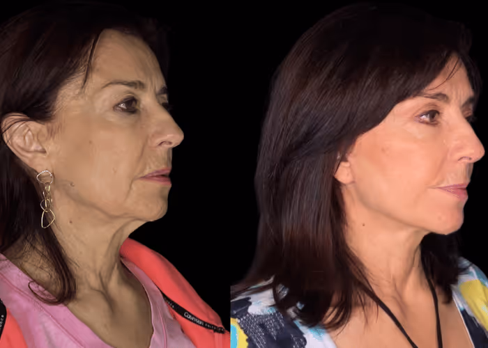 Facelift before and after — female patient, side view