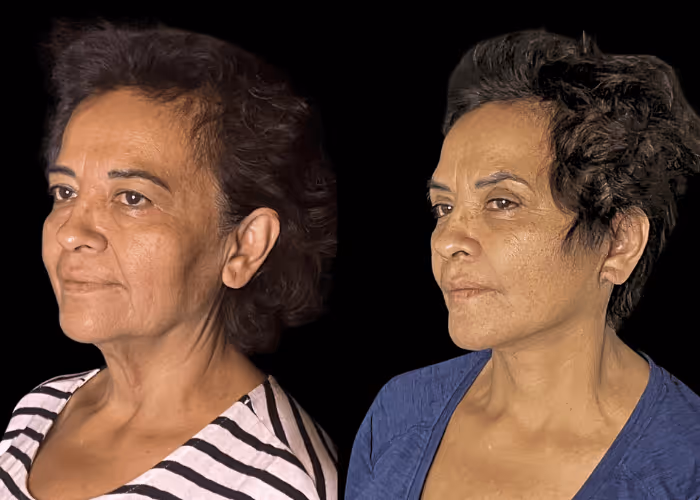 Facelift before and after — female patient, three-quarter view