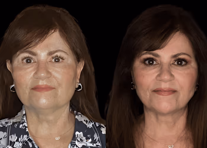 Facelift before and after — female patient, front view